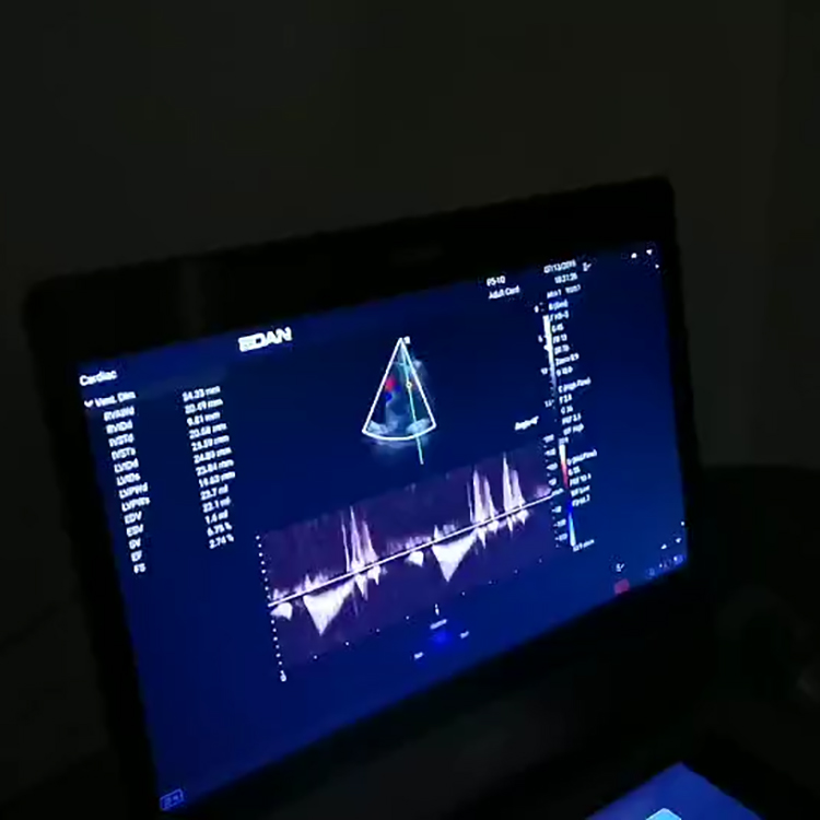 Diseño popular de la máquina de ultrasonido Edan Acclarix AX3 con sonda lineal y convexa