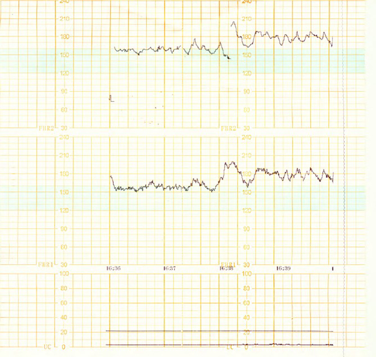 12.1 Pulgadas Pantalla Táctil TFT Impermeable Bebé Frecuencia Cardíaca Fhr/ Ua/ Fm Máquina de Monitoreo Materno Fetal de CTG Diagnóstico